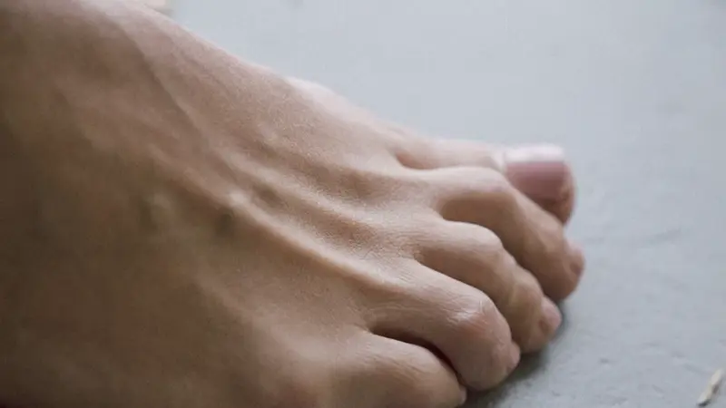 Are Bunions Hereditary? Understanding the Real Cause